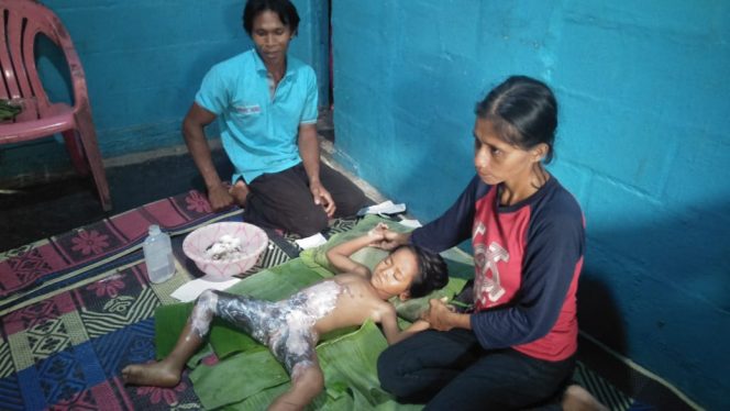 
 caption foto : Inilah kondisi Ramadani Wijaya bocah berusia empat tahun yang tubuhnya terbakar hebat hingga mencapai 50 persen.  